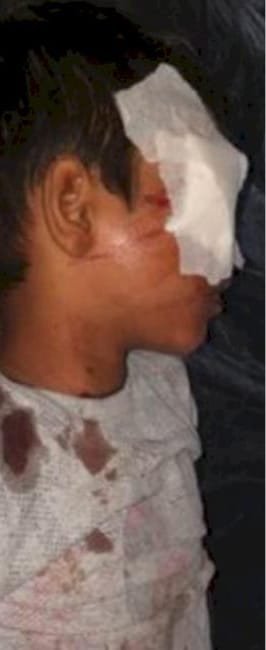 जलते कूड़े में सड़क पर चुने पटाखे फेंकते ही धमाका, किसी की आँख गई तो किसी का हाथ झुलसा, पांच बच्चे गंभीर हालत में पहुँचे अस्पताल