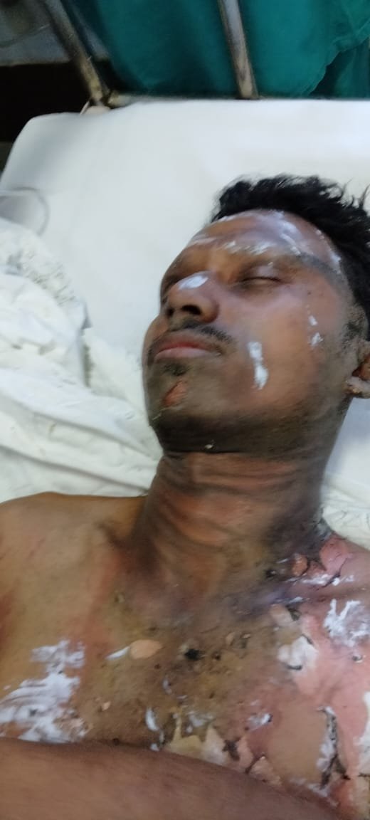 कैपिटल रिपेयरिंग के लिए 8 माह से बंद ब्लास्ट फर्नेस क्रमांक 7 में विस्फोट के बाद उठी आग की लपटें, एक ठेका श्रमिक की मौत, दूसरा 90% झुलसा, प्रबंधन ने जांच के दिए आदेश