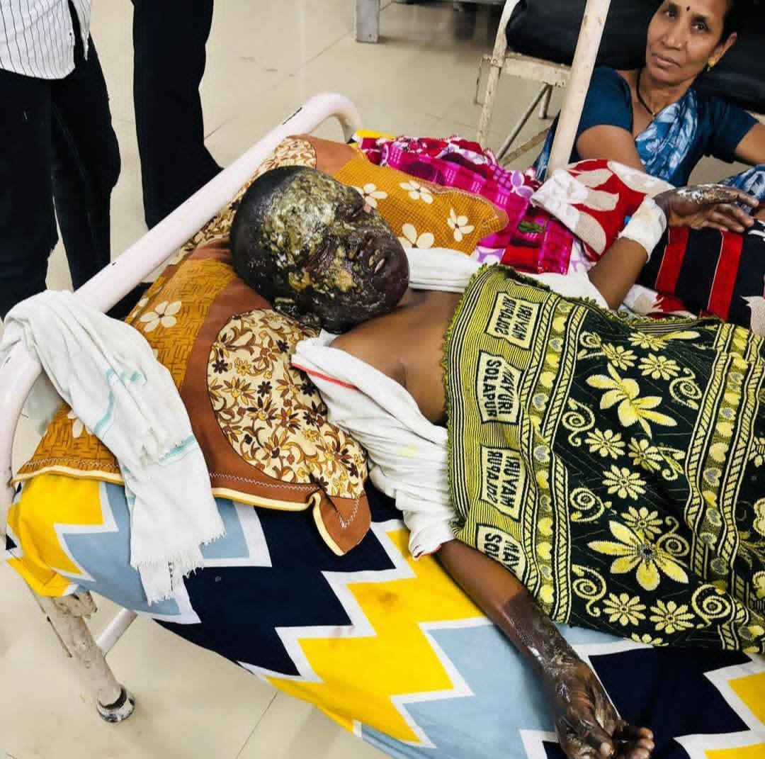 दुर्ग में झुलसे अभिषेक के बेहतर उपचार के लिए विधायक रिकेश की पहल