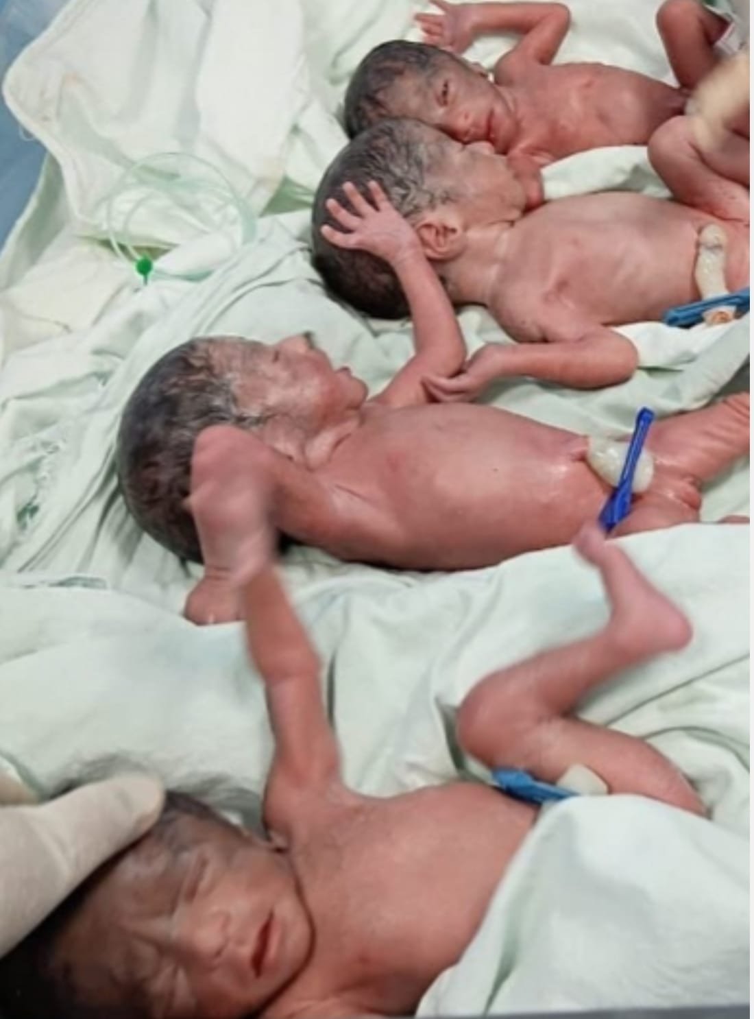 CG News : एक साथ 4 बच्चों का जन्म, डॉक्टरों की विशेष निगरानी में